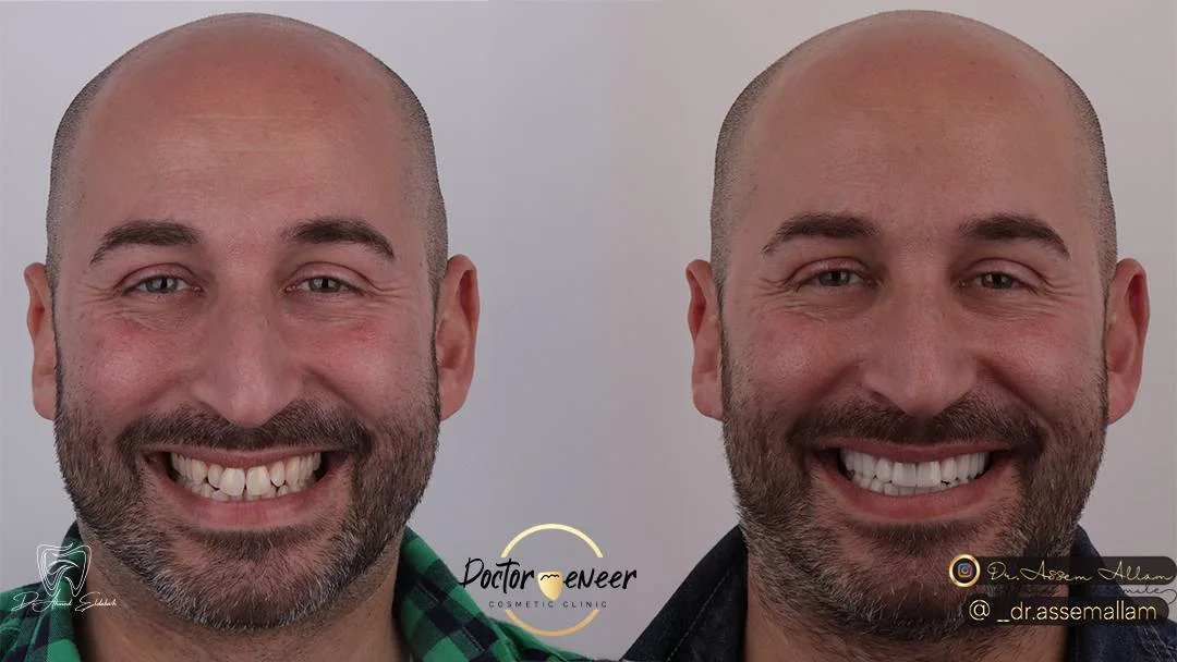 Simone Before and After